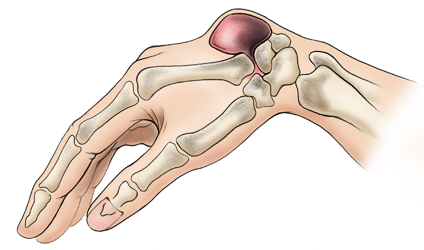 Diagram of ganglion cyst on back of wrist