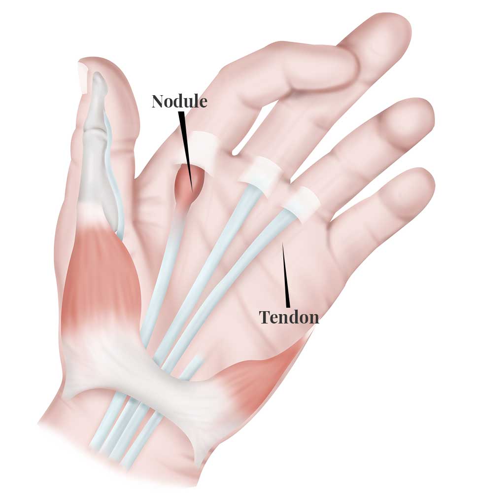 Trigger finger diagram